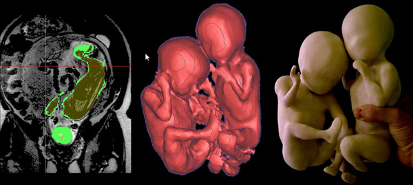 impression 3d echographie