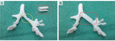 Prothèse trachée 3D