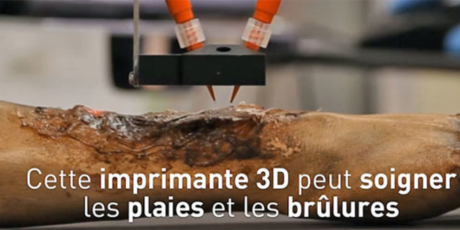 imprimante 3D peau brulure